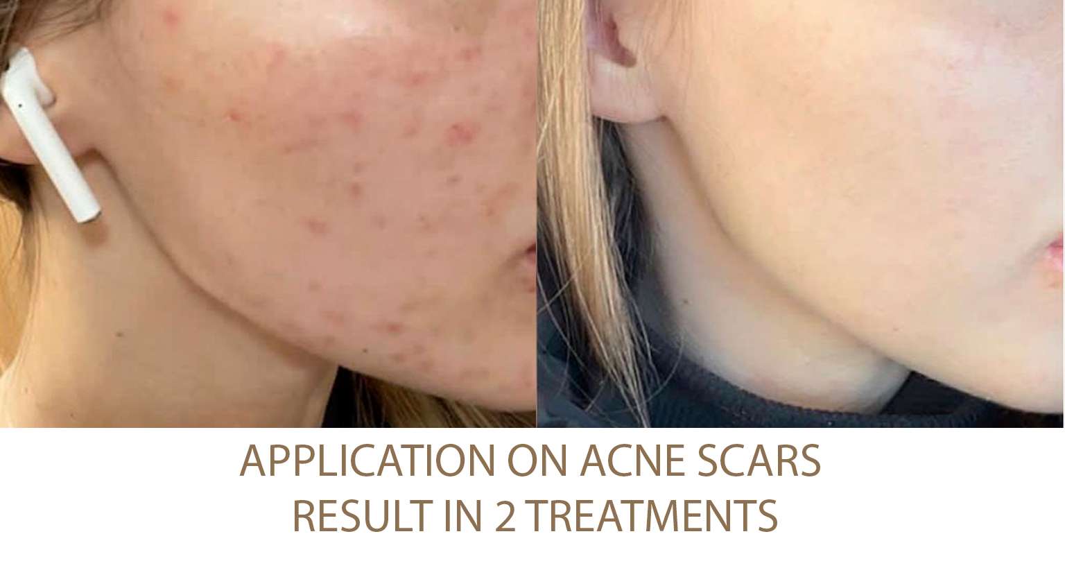 Acne-scars
