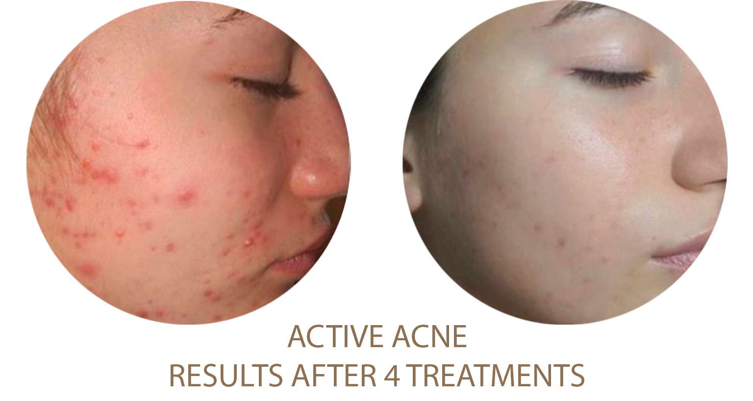 Active-acne1