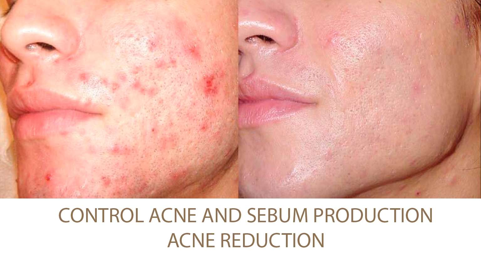 Acne Reduction NYC