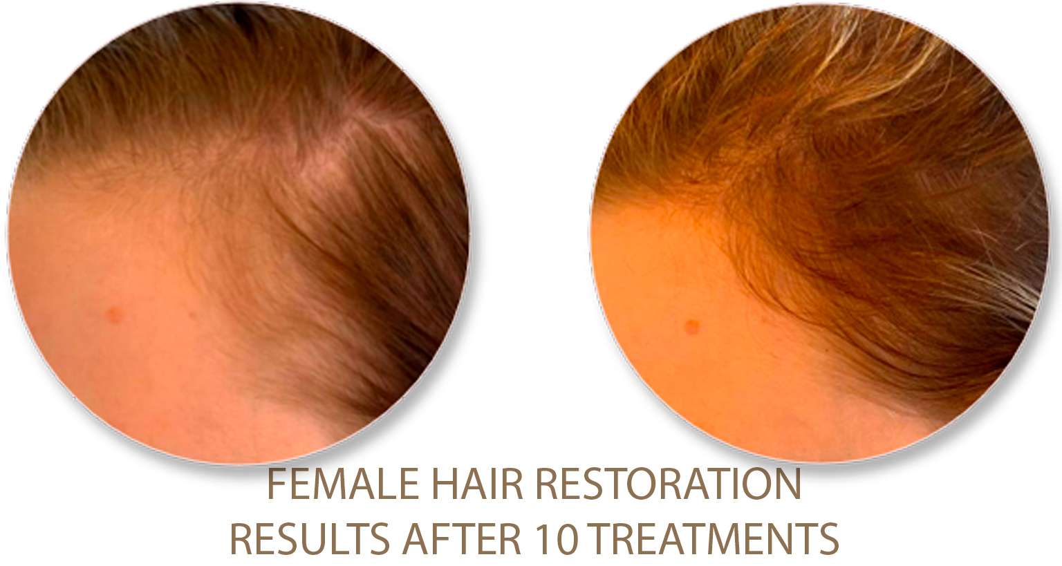 Female-hair-restoration
