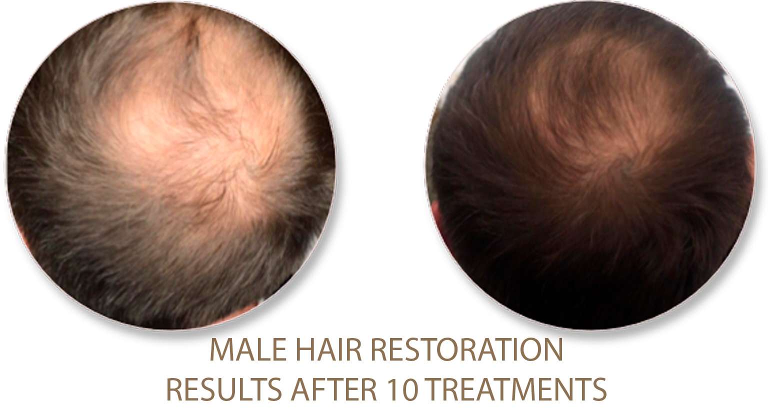 Male-hair-restoration