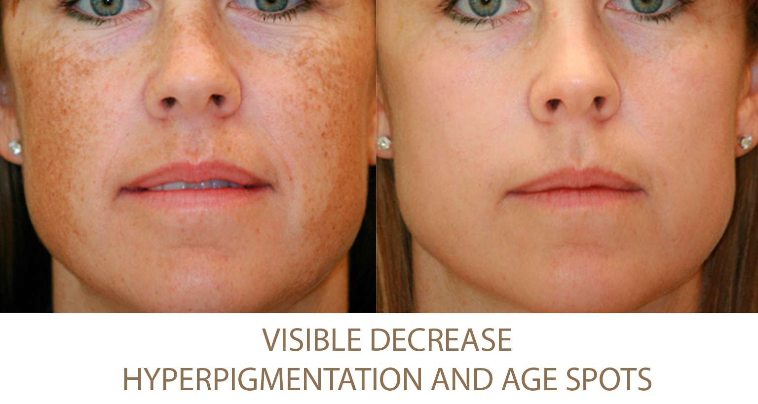 Hyperpigmentation Treatment NYC