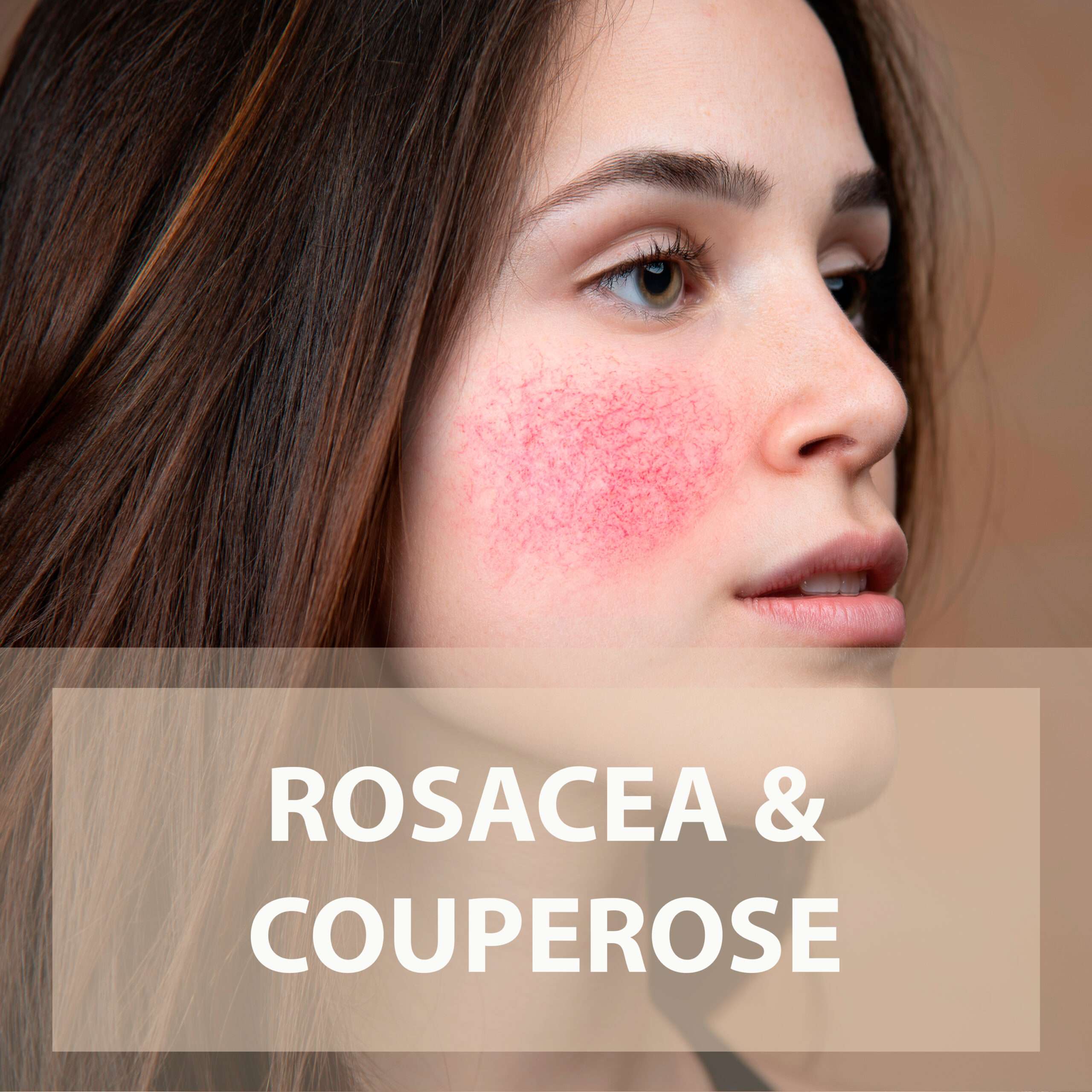 Rosacea Couperose Solution