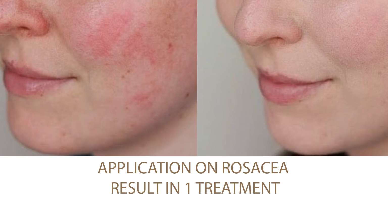 Rosacea-treatment