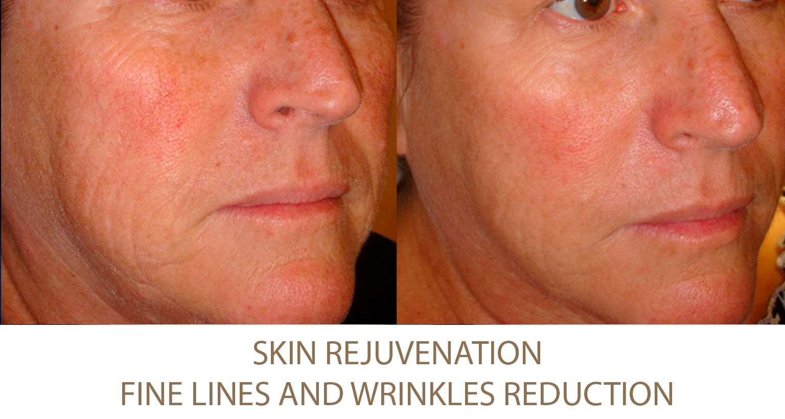 Fine Lines Reduction NYC
