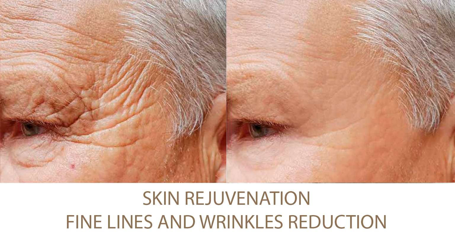 Skin Rejuvenation Wrinkles Reduction