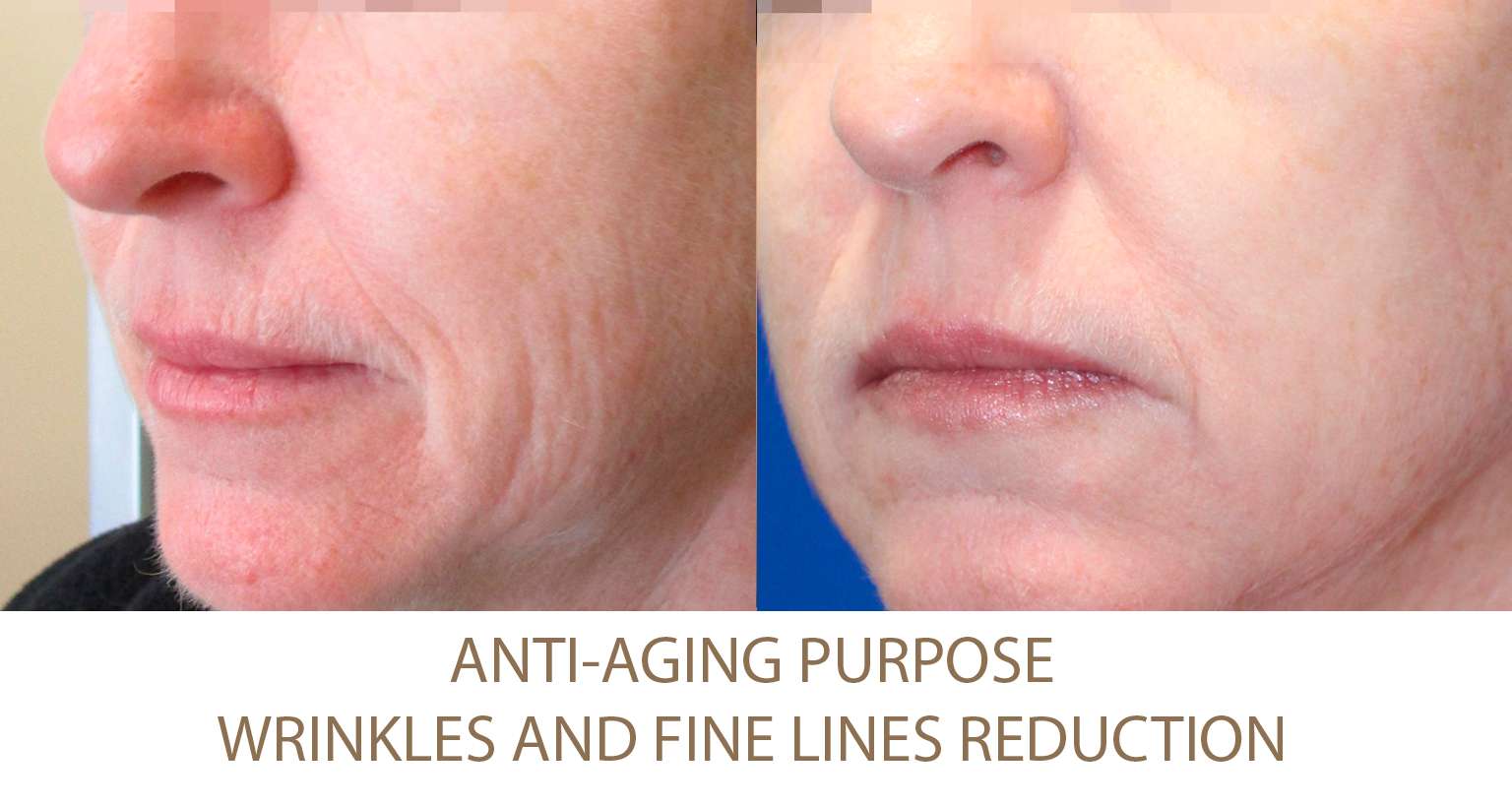 Wrinkles-reduction