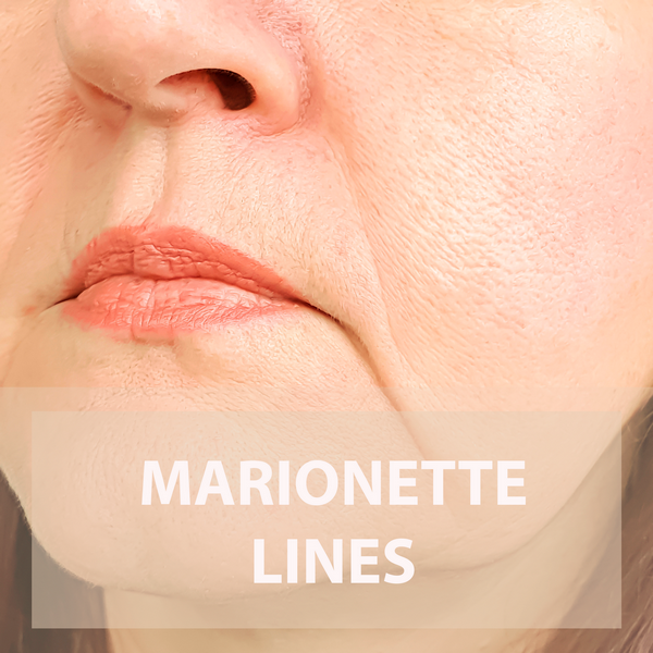 Marionette lines treatment in New York