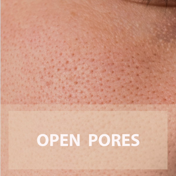 Open Pores treatment
