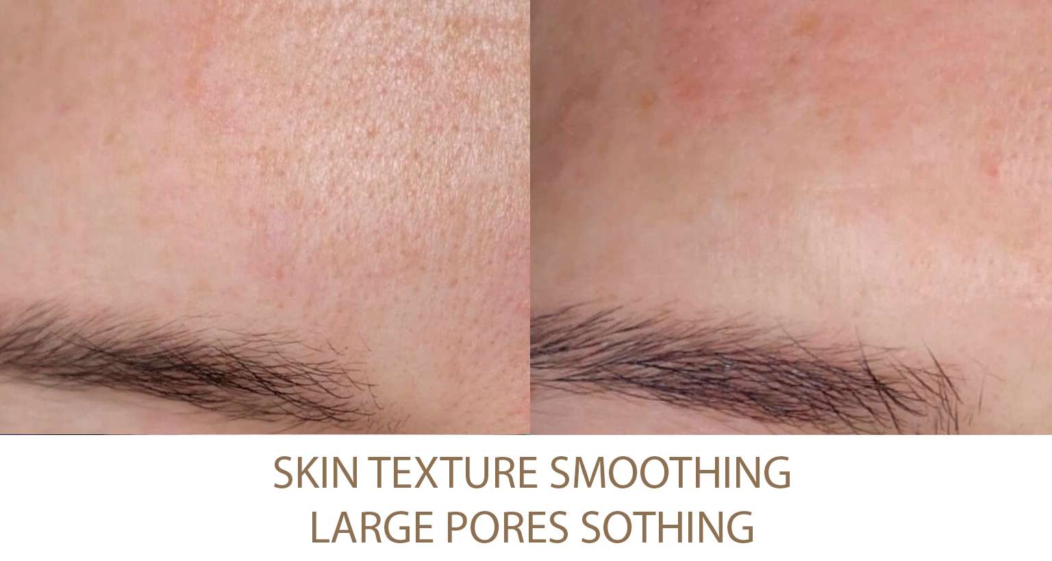 Skin Smoothing procedure Beautypro