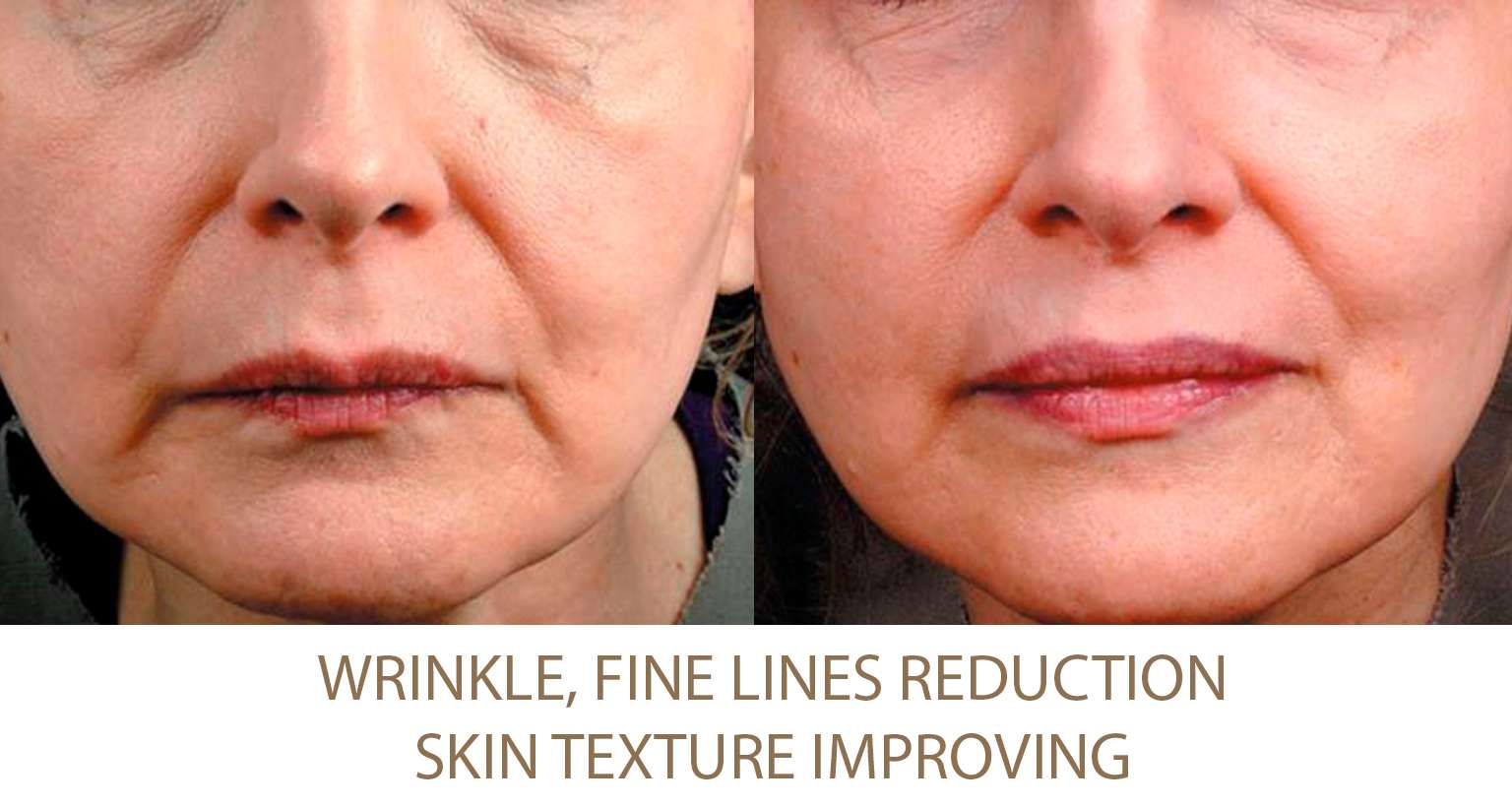 Wrinkles reduction BeautyPro