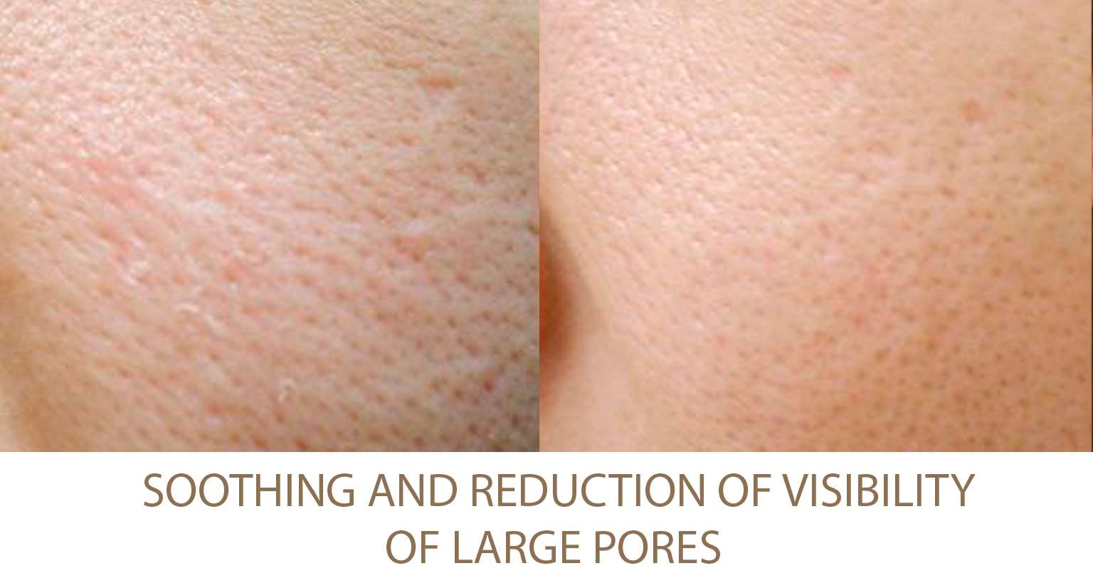 Skin pore reduction Beautypro