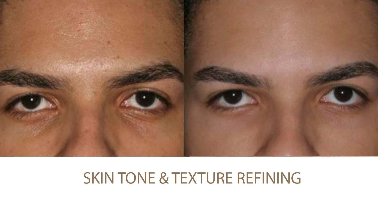 Skin tone refining and Skin texture refining in Beautypro New York