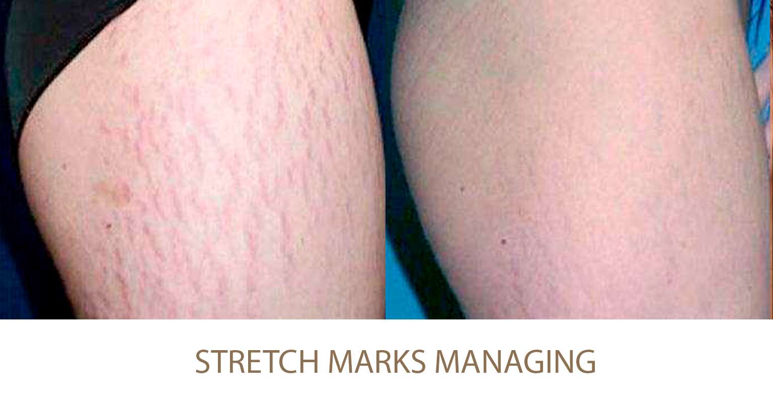 How to remove stretch marks? Beautypro answer
