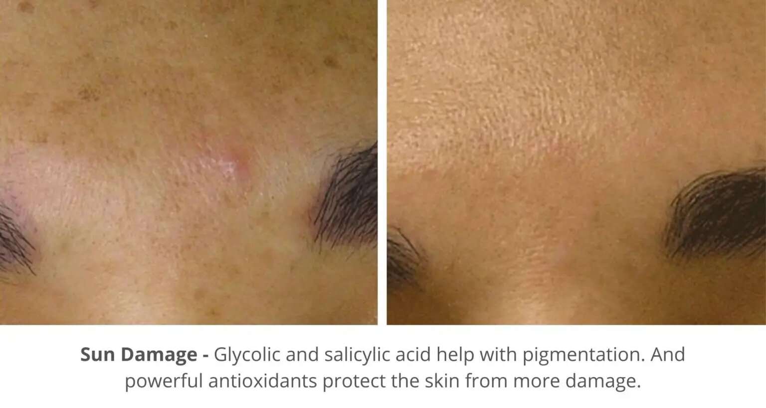Sun spot skin treatment Beautypro