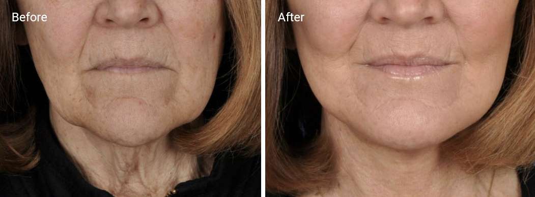 Skin tightening Before and After