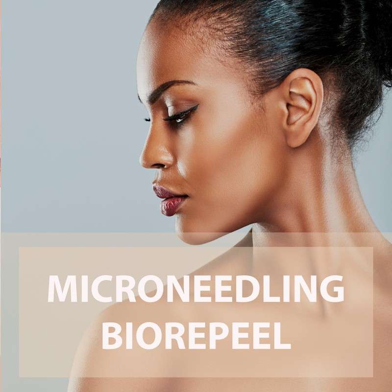 Microneedling Biorepeel what is it