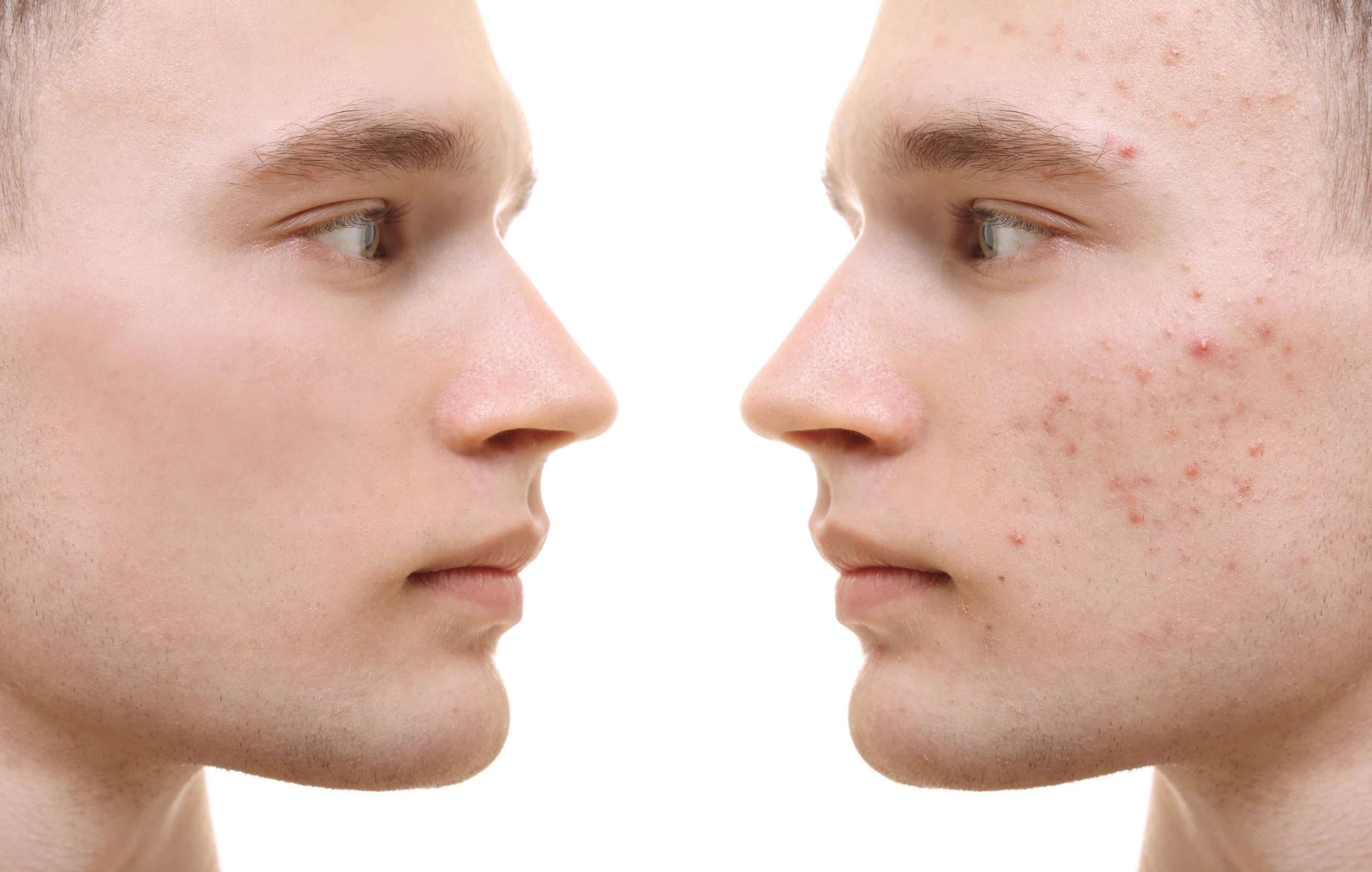 Acne treatment before and after Beautypro NYC