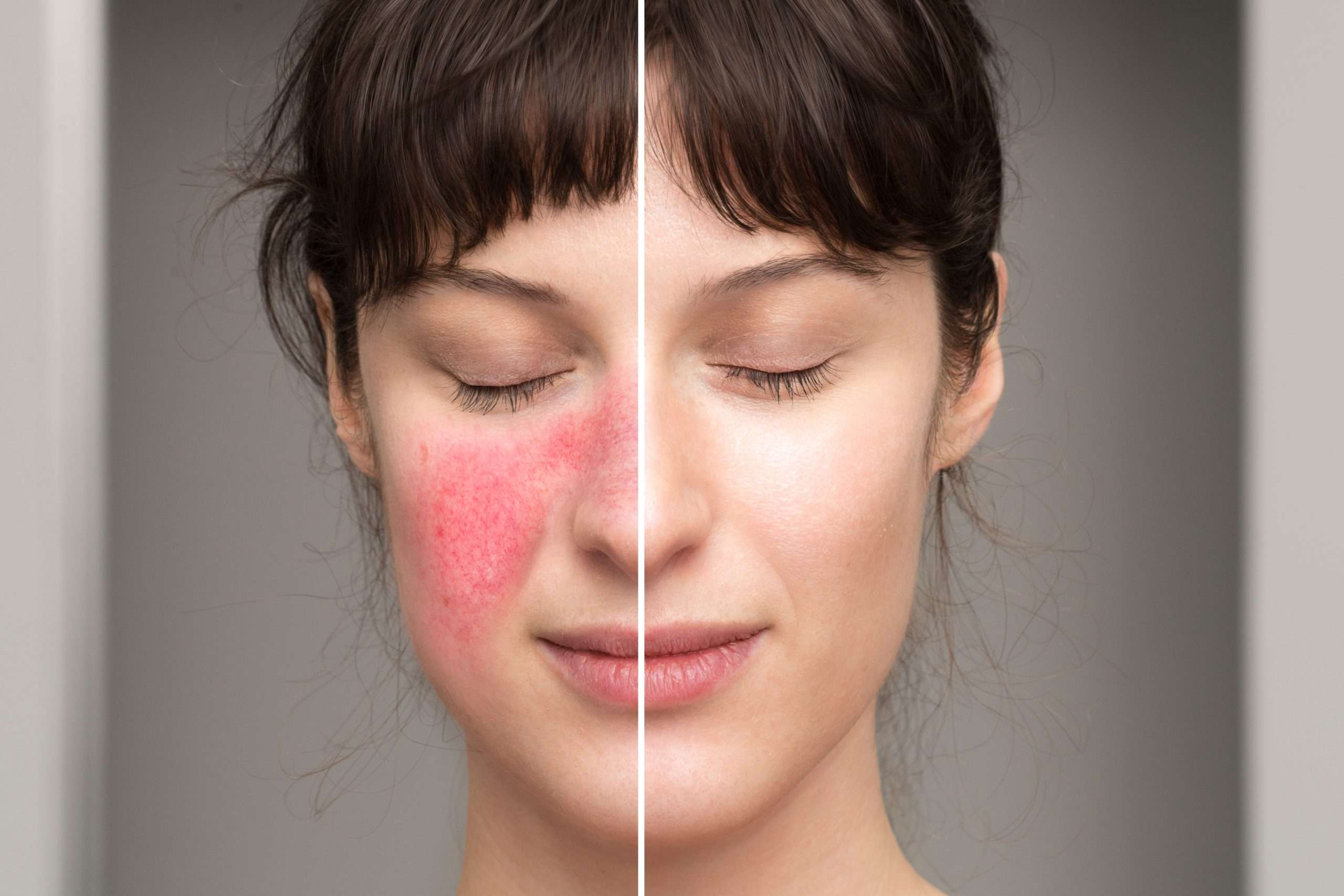 Rosacea Solution Cosmetology