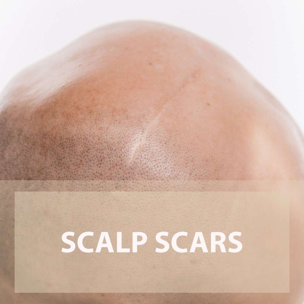 scalp scars treatment in New York