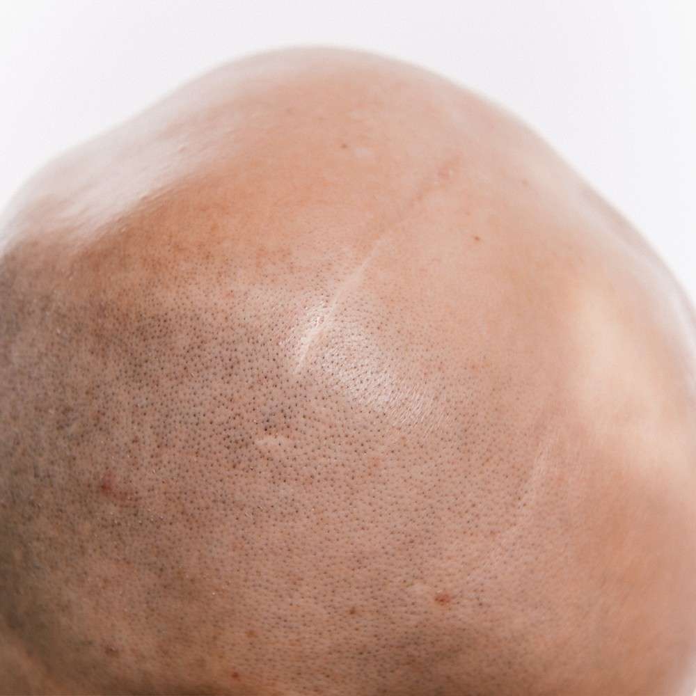 scalp scars